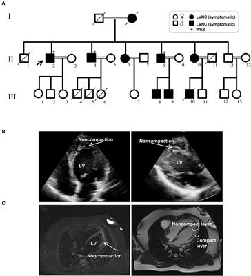 A Novel Missense Variant in Actin Binding Domain of MYH7 Is Associated With Left Ventricular Noncompaction